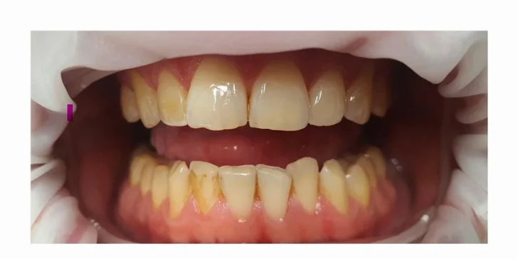 Dentálna hygiena pre deti aj dospelých alebo bielenie zubov v Mary´s Dental