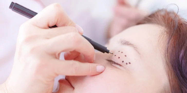 Blefaroplastika: Korekcia horných viečok v Magnifica Clinic