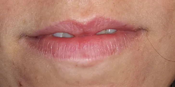 Výplň pier kyselinou hyalurónovou