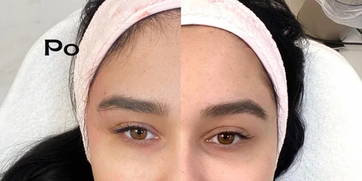Dajte svojmu pohľadu nový rozmer aplikáciou liftingových nití do okolia očí vo Fabulous beauty