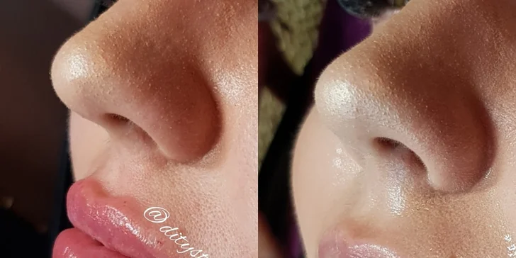 Russian lips: Výplň a modelácia pier kyselinou hyalurónovou