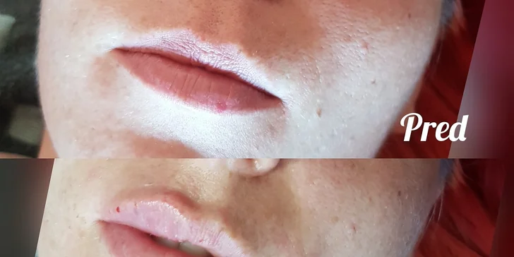 Russian lips: Výplň a modelácia pier kyselinou hyalurónovou