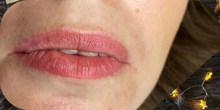 Russian lips: Výplň a modelácia pier kyselinou hyalurónovou