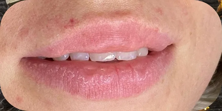 Russian lips: Výplň a modelácia pier kyselinou hyalurónovou
