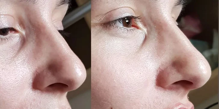 Russian lips: Výplň a modelácia pier kyselinou hyalurónovou