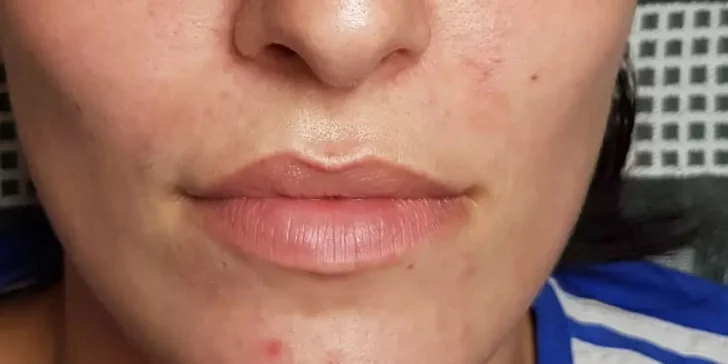 Russian lips: Výplň a modelácia pier kyselinou hyalurónovou
