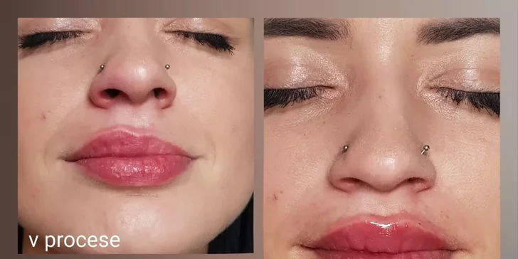 Russian lips: Výplň a modelácia pier kyselinou hyalurónovou