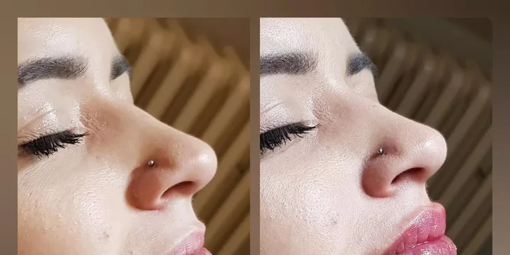 Russian lips: Výplň a modelácia pier kyselinou hyalurónovou