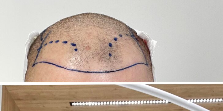 Transplantácia vlasov na špičkovej klinike v Istanbule