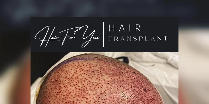 Transplantácia vlasov na špičkovej klinike v Istanbule