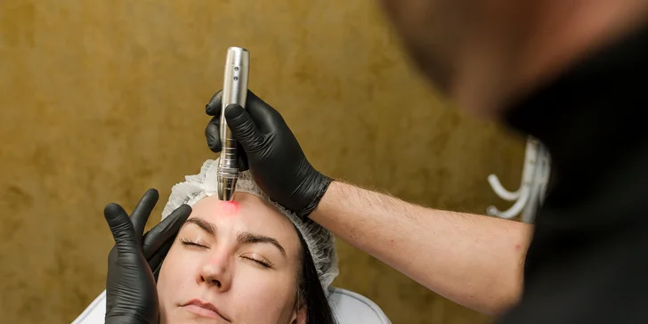 Vyhladenie vrások, nadvihnutie viečok a Mikroihličková mezoterapia pre krásnu pleť