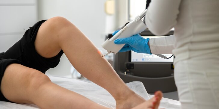 Vstupná konzultácia a 30% zľava na laserové odstránenie metličkovitých cievok na nohách na klinike jednodňovej chirurgie Revive