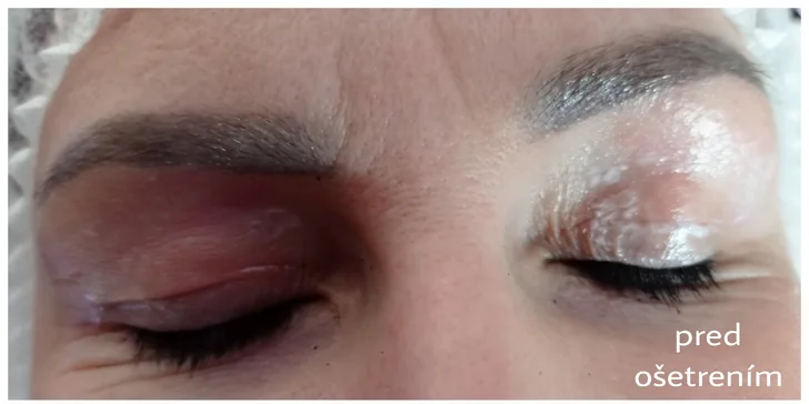 Vyhladenie vrások, nadvihnutie viečok a Mikroihličková mezoterapia pre krásnu pleť