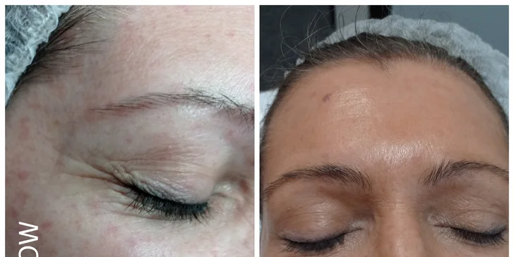 Permanentný make-up BB Glow alebo Microneedling pre krásnu pleť