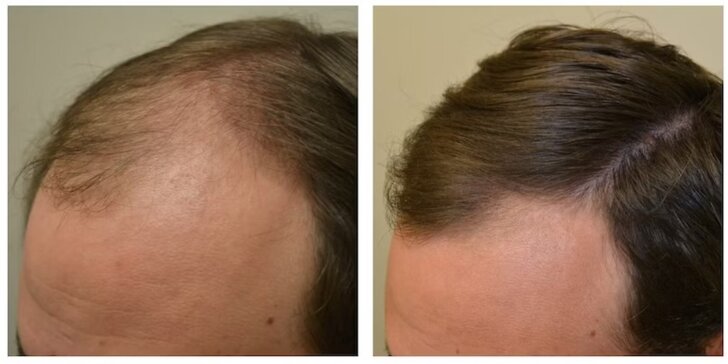 Zabojujte s alopéciou a vypadávaním vlasov - obnovte a stimulujte ich rast pomocou neinvazívnej mezoterapie!