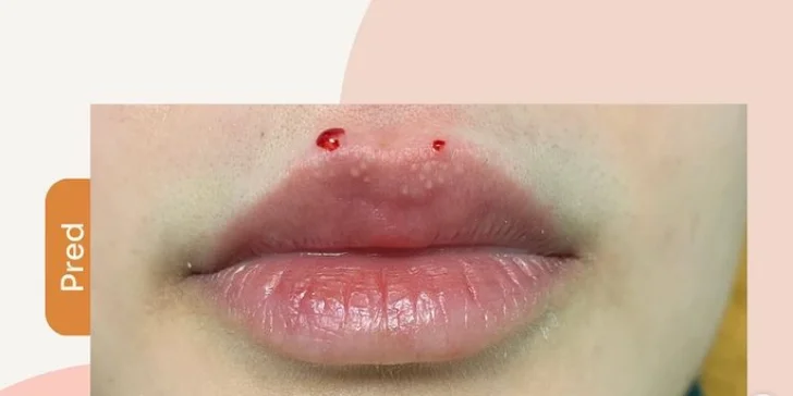 Šťavnaté pery po celý rok: Výplň pier kyselinou hyalurónovou Teosyal®