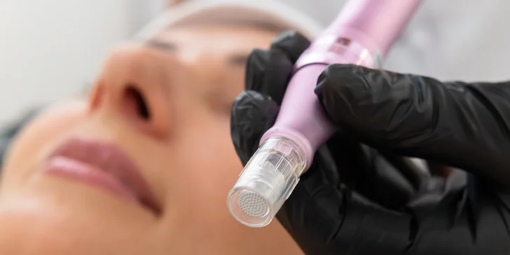 Mezoterapia tváre s dermapenom, liftingové ošetrenie s rádiofrekvenciou alebo PRX-T33
