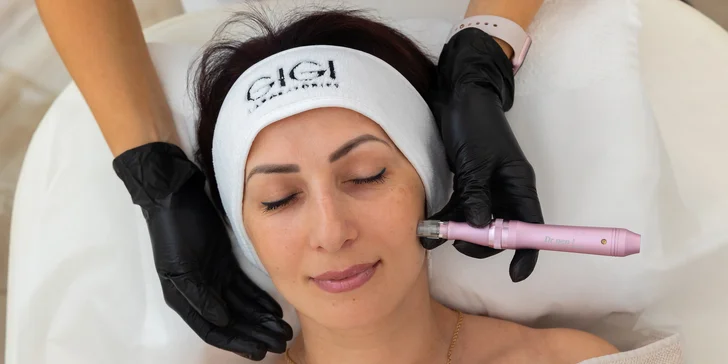 Mezoterapia tváre s dermapenom, liftingové ošetrenie s rádiofrekvenciou alebo PRX-T33