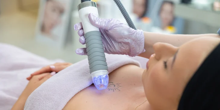 Vivace: Mikroihličková rádiofrekvencia s carbon peelingom pre aknóznu aj starnúcu pleť