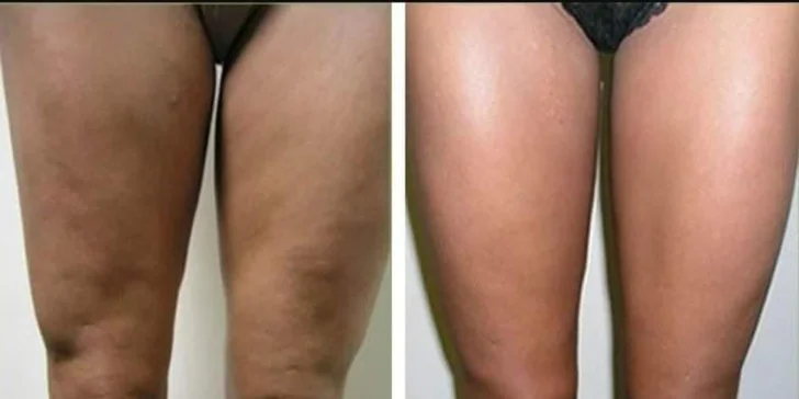 Anticelulitídna masáž valčekmi v Diva Beauty na boky, stehná, brucho aj zadok