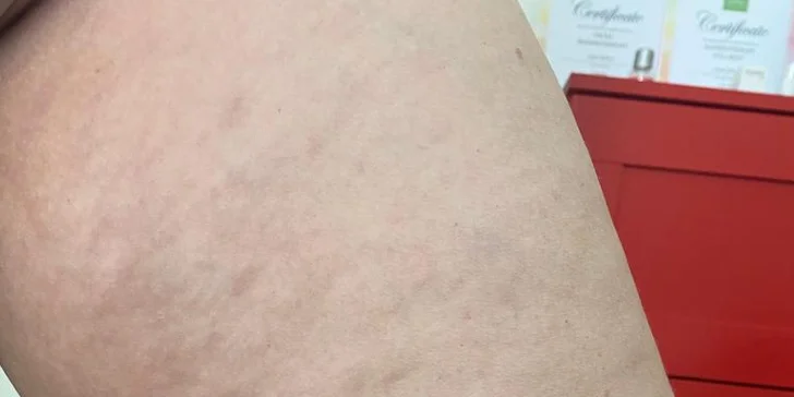 Anticelulitídna masáž valčekmi v Diva Beauty na boky, stehná, brucho aj zadok