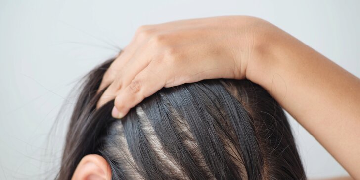 Vypadávanie a riedke vlasy -obnovte ich rast pomocou mezoterapie ktorá naozaj funguje!