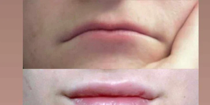 Hydratácia alebo zvýraznenie pier kyselinou hyalurónovou
