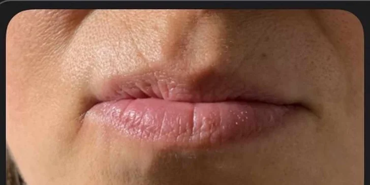 Hydratácia alebo zvýraznenie pier kyselinou hyalurónovou