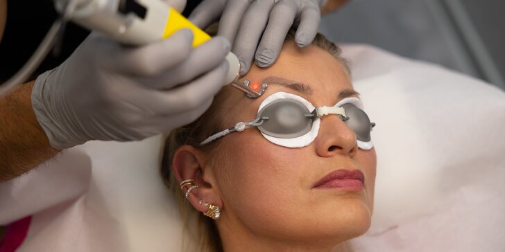 Odstránenie permanentného make-upu obočia pomocou lasera