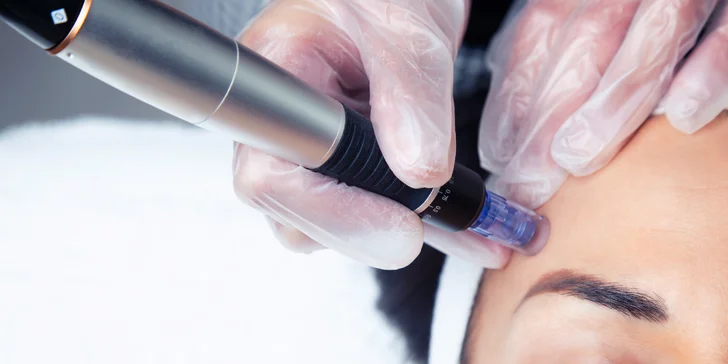Kozmetické ošetrenia v salóne Stella: Mikrodermabrázia, chemický peeling, ihličková mezoterapia a iné