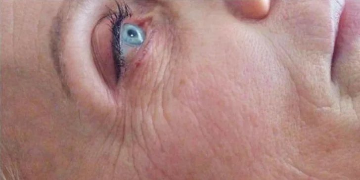 Okamžité vyhladenie vrások podľa tradičnej čínskej medicíny