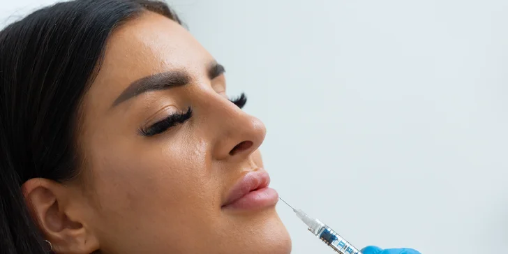Russian lips, výplň a hydratácia pier kyselinou hyalurónovou