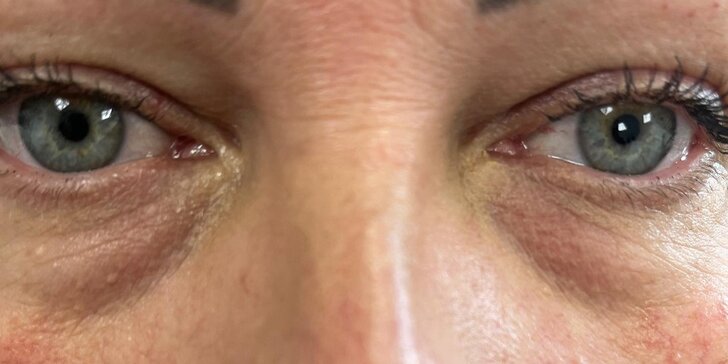 Omladenie očného okolia pomocou injekčnej aplikácie peptidu Lumi Eyes
