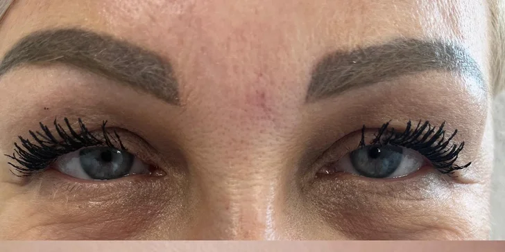 Omladenie očného okolia pomocou injekčnej aplikácie peptidu Lumi Eyes