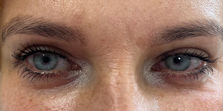 Omladenie očného okolia pomocou injekčnej aplikácie peptidu Lumi Eyes