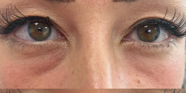 Omladenie očného okolia pomocou injekčnej aplikácie peptidu Lumi Eyes