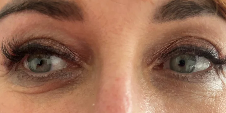 Omladenie očného okolia pomocou injekčnej aplikácie peptidu Lumi Eyes