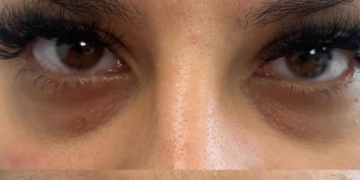 Omladenie očného okolia pomocou injekčnej aplikácie peptidu Lumi Eyes