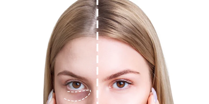 Omladenie očného okolia pomocou injekčnej aplikácie peptidu Lumi Eyes