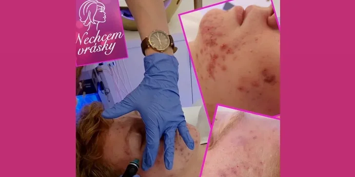 Nechcem vrásky: Jedinečné ošetrenia pleti HydraFacial Elite Basic alebo Lux
