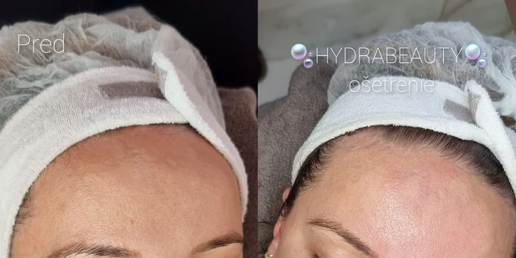 Ošetrenia pleti: hydrabeauty, anti-age alebo pre problematickú pleť v salóne Beauty by Vladik