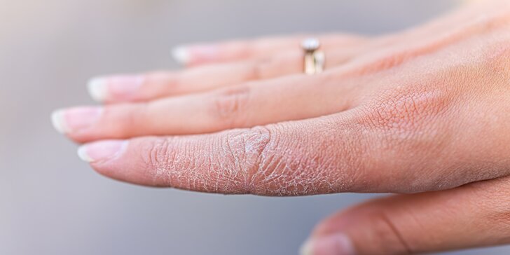 Odstránenie suchej a popraskanej pokožky rúk s kyselinou hyalurónovou