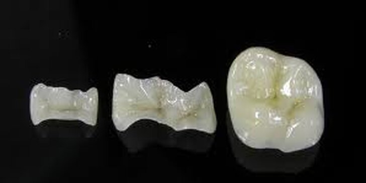 Keramická výplň zuba zhotovená pri jednej návšteve