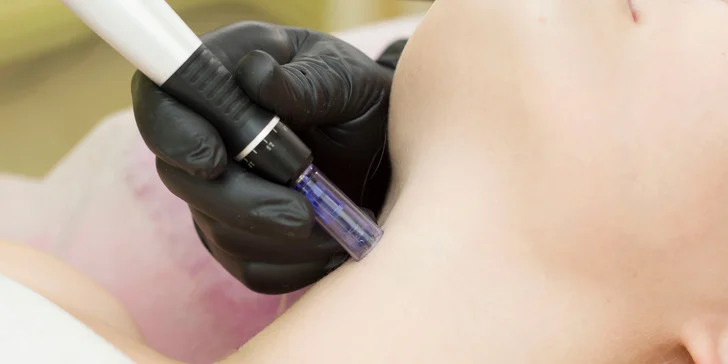 Esteľ by Dr. Žaneta: Lekársky chemický peeling alebo potlačenie pigmentácie mezoterapiou