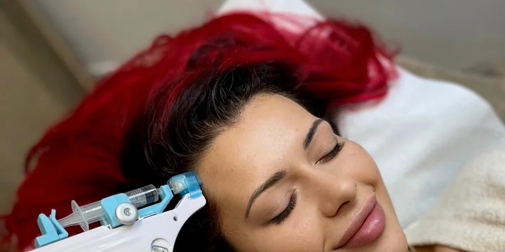 Jemný lifting aj prevencia proti vráskam: Mezoterapia pleti Vital Injectorom