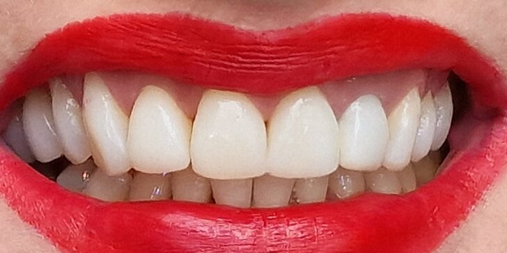 Domáce alebo ambulantné bielenie zubov najnovším systémom Philips ZOOM