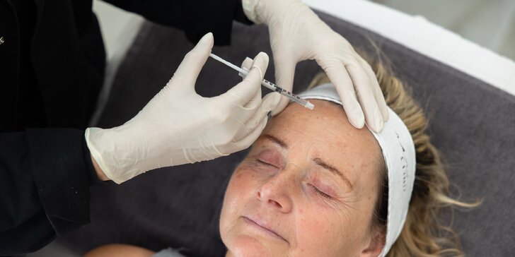 Odstránenie mimických vrások pomocou botulotoxínu na čele, v okolí očí a v medziobočí