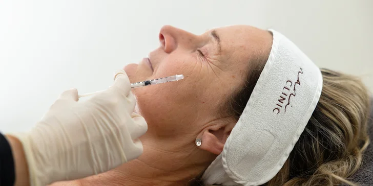 Odstránenie mimických vrások pomocou botulotoxínu na čele, v okolí očí a v medziobočí