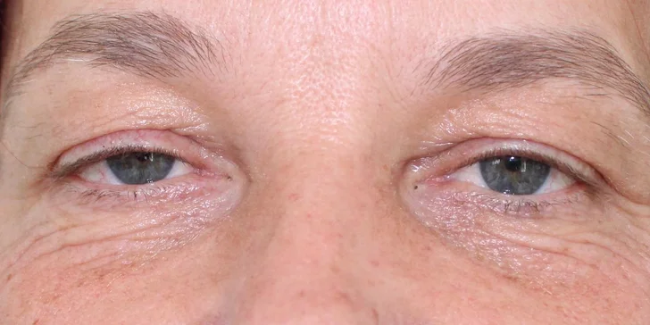 Lifting čela a viečok: Operácia horných viečok alebo Direct browlift s efektom blefaroplastiky