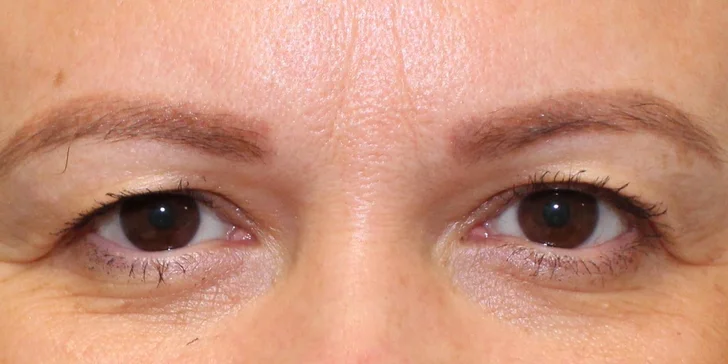 Lifting čela a viečok: Operácia horných viečok alebo Direct browlift s efektom blefaroplastiky